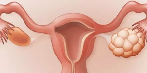 ما هو تكيس المبايض وكيفية علاجه والشفاء منه؟ 2 هو تكيس المبايض وكيفية علاجه