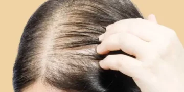 التفاصيل| أفضل علاج للصلع عند النساء 2 التفاصيل| أفضل علاج للصلع عند النساء