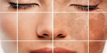 كيفية إزالة تصبغات الوجه في أسبوع لوجه نضر ومشرق