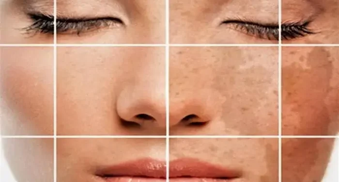 كيفية إزالة تصبغات الوجه في أسبوع لوجه نضر ومشرق