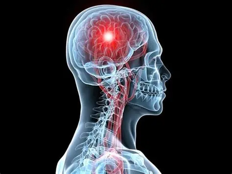 الجلطة الدماغية عند الشباب.. الأعراض والأسباب وطرق الوقاية 1 الجلطة الدماغية عند الشباب
