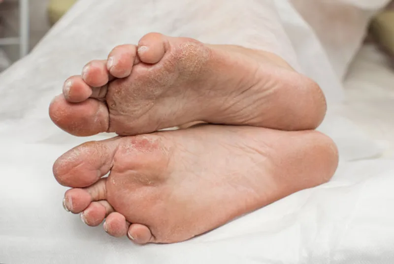 القدم السكري.. الأعراض والمضاعفات وسبل العلاج 4 القدم السكري