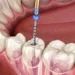 ألم حشو العصب.. متى يجب زيارة الطبيب؟ 10 ألم حشو العصب