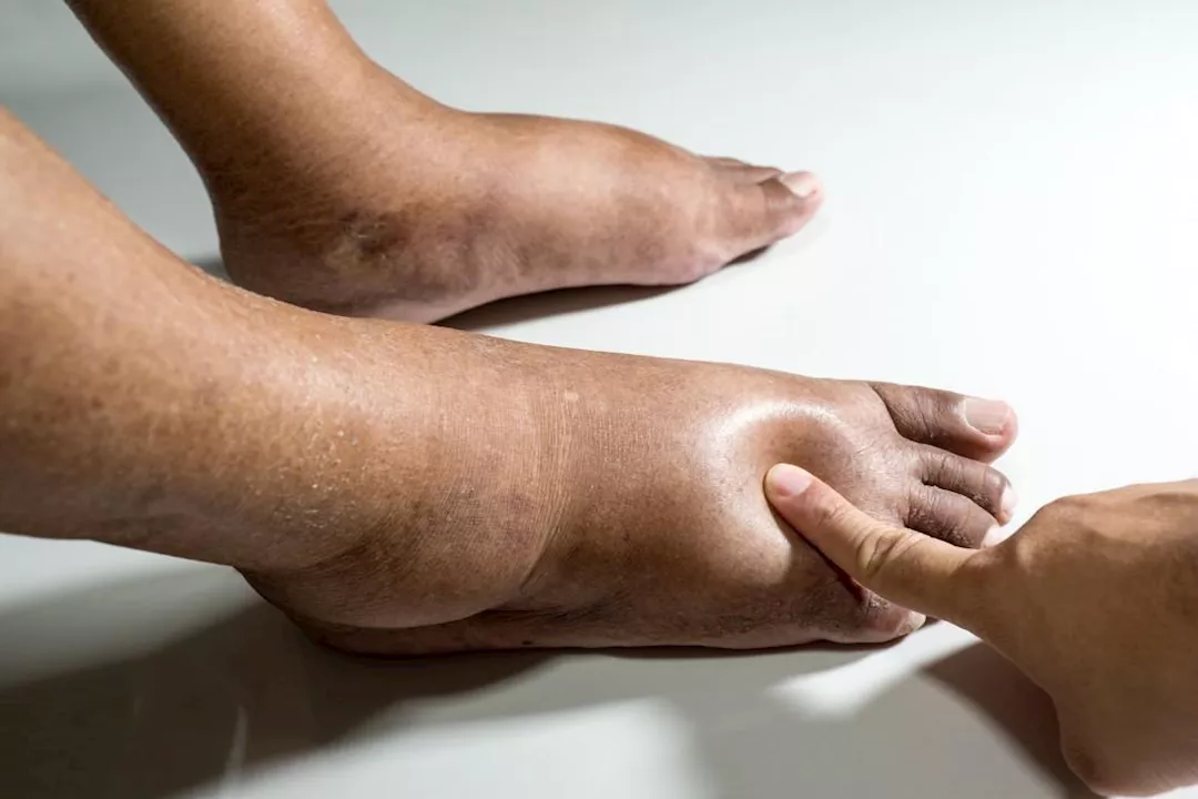 القدم السكري.. الأعراض والمضاعفات وسبل العلاج 2 القدم السكري